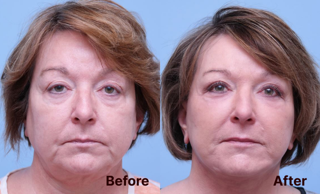 Before and After Facelift by Midwest Facial Plastic Surgery